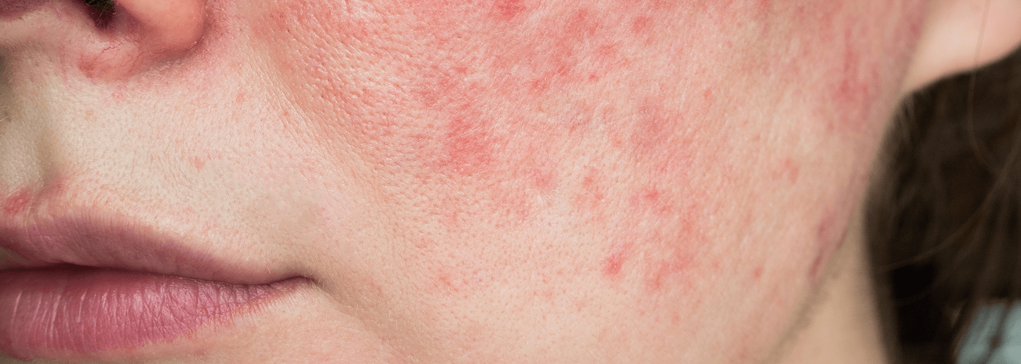 Rosacea - vad gör man?