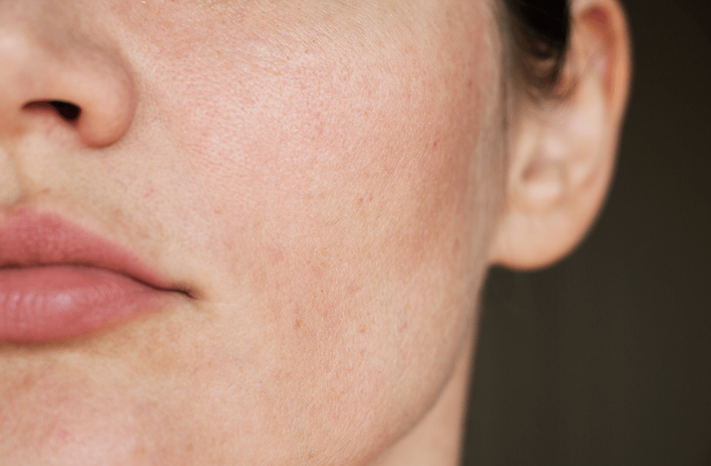 kemisk peeling med syror