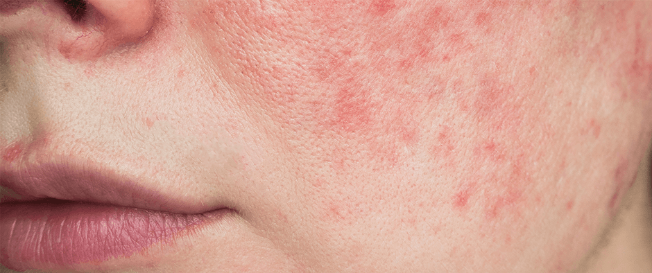 Rosacea - vad gör man?