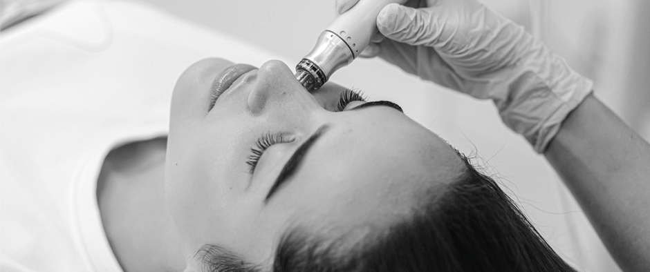 Gör microneedling och bli av med akneärr