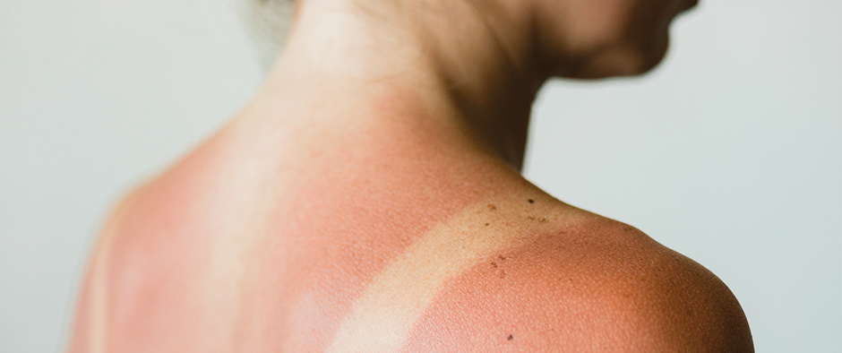 Glömde du solskydd igår? Så här tar du hand om huden idag!