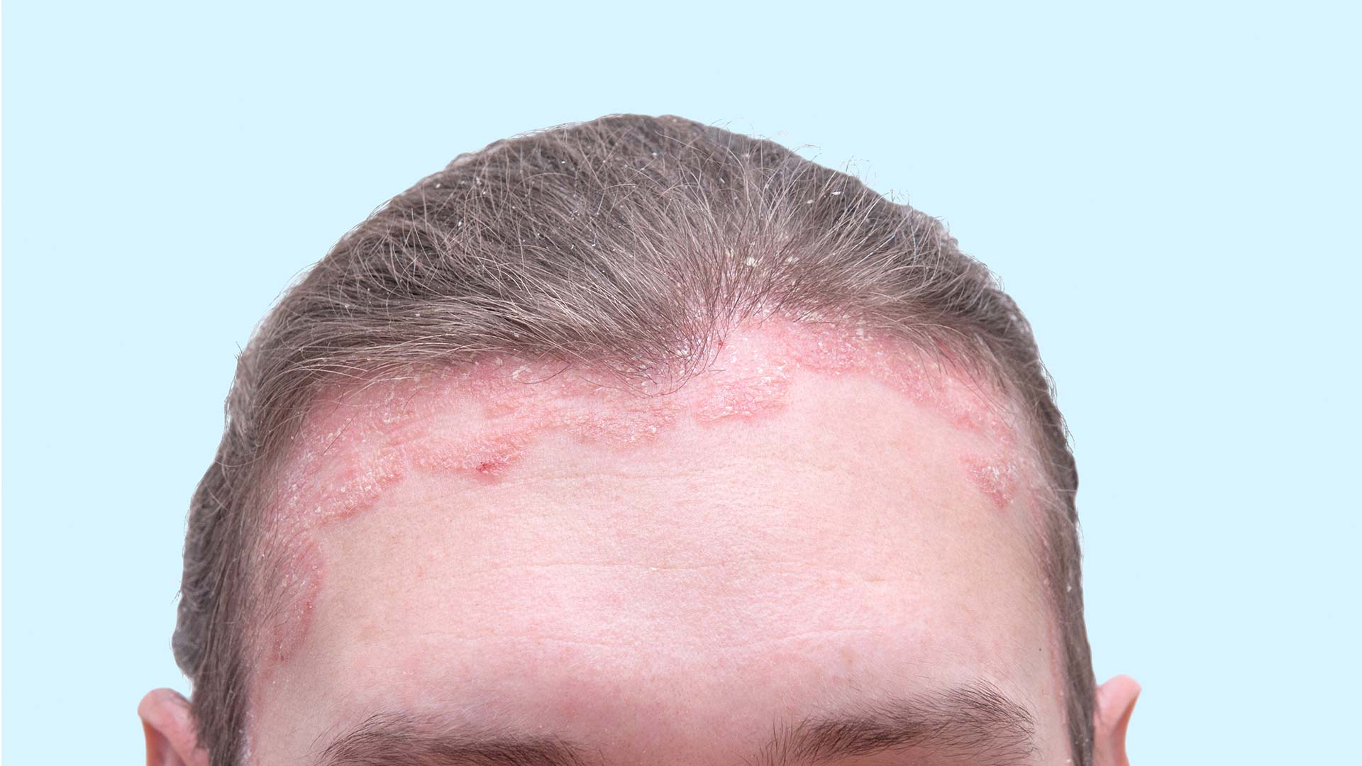 Hårbottenpsoriasis