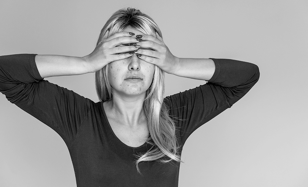 5 tips till dig med Akne