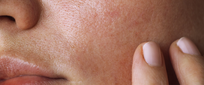 Låt våra hudterapeuter analysera din hud digitalt