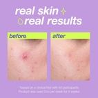 Dermalogica Clear Start Breakout Clearing Liquid Peel 30 ml