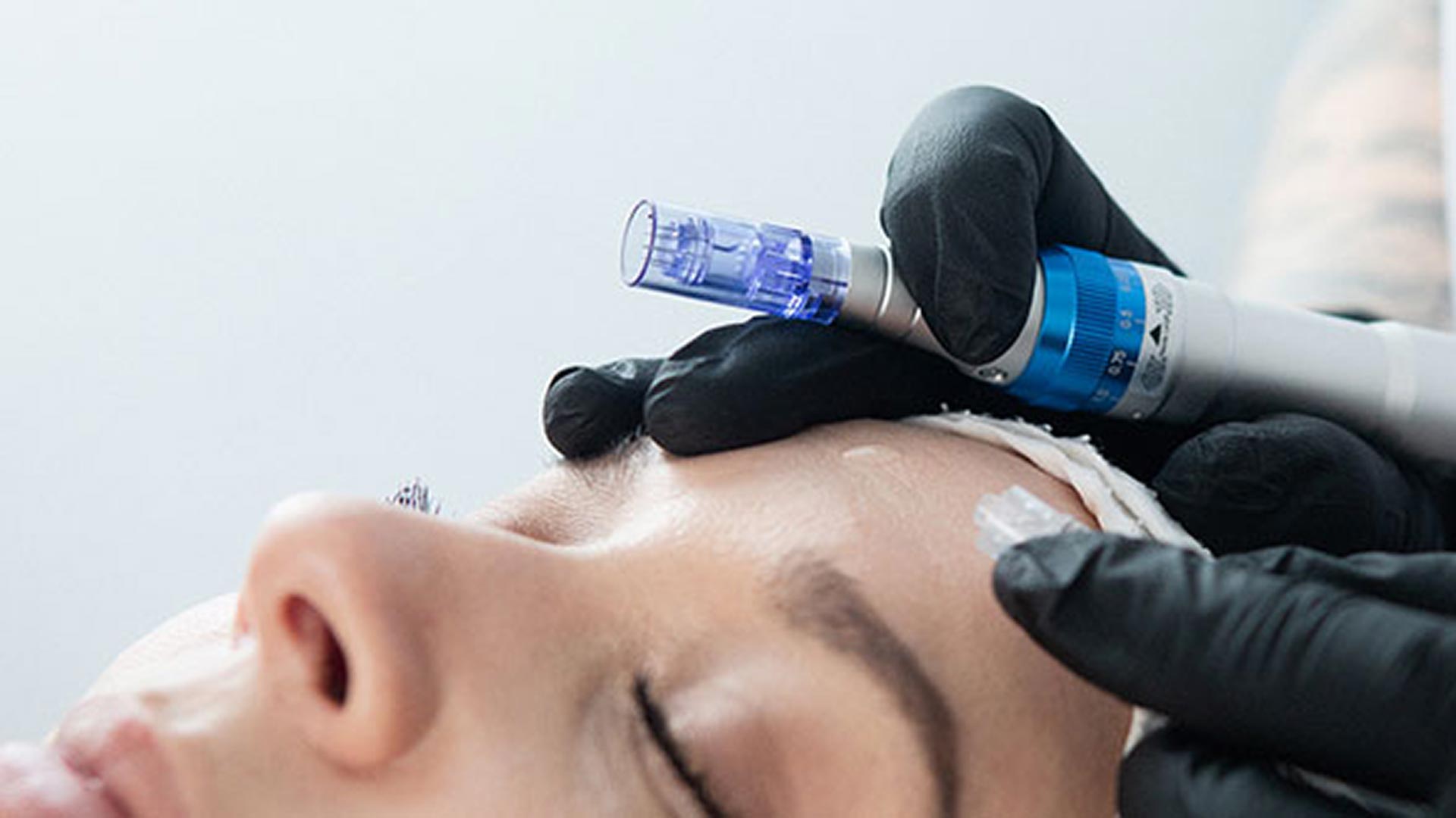 Behandling: Microneedling så funkar det