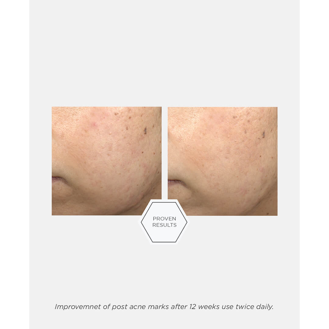 Neostrata Post Acne Mark Correcting Serum 30 ml
