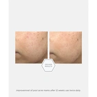 Neostrata Post Acne Mark Correcting Serum 30 ml