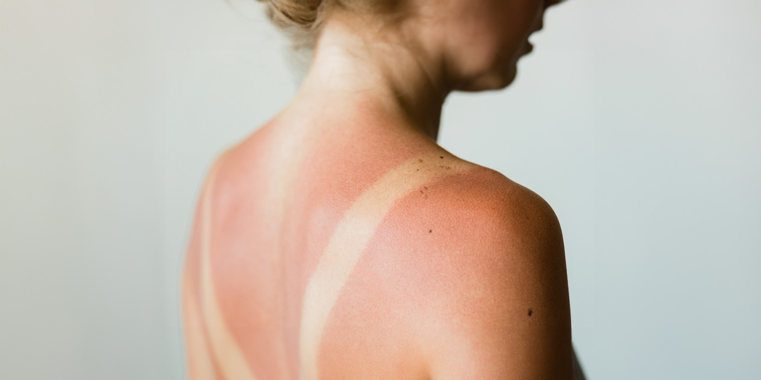 Varför du borde använda en aftersun i sommar