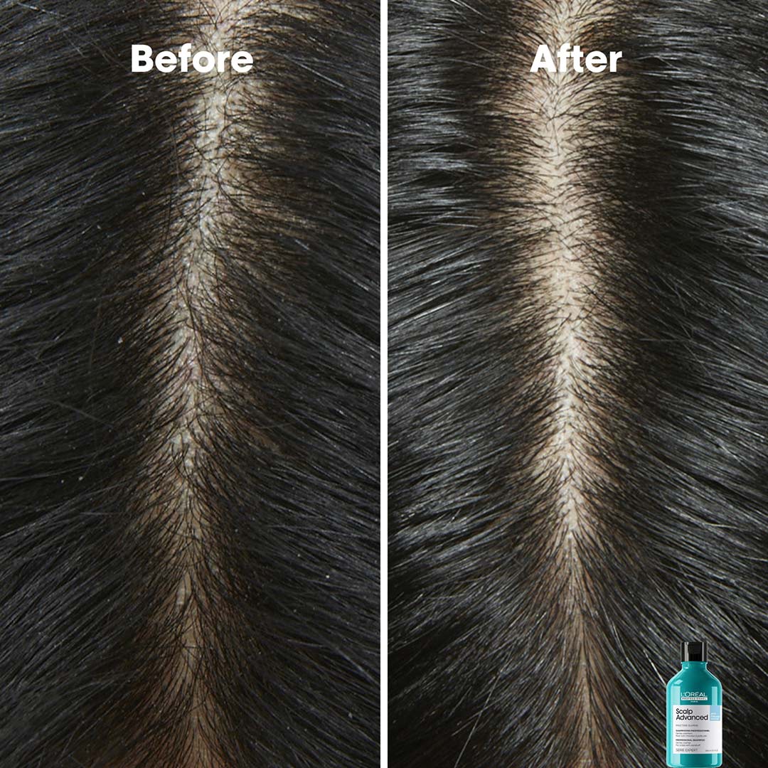 Loreal Professionnel Scalp Advanced Anti-Dandruff Shampoo 300 ml