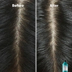 L´Oréal Professionnel Scalp Advanced Anti-Dandruff Shampoo 300 ml
